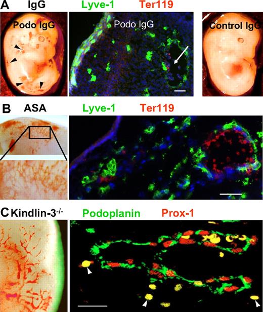 Figure 4. Inhibition of platelet aggregation causes a “nonseparation” phenotype. (A) E13.5 podoplanin+/+ embryo whose mother was injected with rabbit anti-podoplanin IgG that blocks podoplanin-platelet interaction (left panel). Subtle vascular malformations (arrowheads) similar to those in podoplanin−/− mice are locally observed. Immunofluorescence staining (middle panel) demonstrates dermal Lyve-1+ lymphatic vessels (green) containing erythrocytes (red; white arrow). Cell nuclei are stained with DAPI (blue). Right panel shows macroscopically normal vasculature in podoplanin+/+ embryo whose mother was injected with irrelevant rabbit IgG. (B) E14.5 podoplanin+/+ embryo whose mother was treated with acetyl salicylic acid (ASA; 25 mg/kg/d) to inhibit platelet aggregation. Vascular lesions reminiscent of those found in podoplanin−/− mice are locally observed (left panel; inset shows higher magnification). Immunofluorescence staining (right panel) shows that the dermal vessels are Lyve-1+ lymphatics (green) and contain erythrocytes (Ter119 in red). Cell nuclei are stained with DAPI (blue). (C) Kindlin-3−/− E14.0 embryo that shows blood-containing vascular malformations in the skin (left panel). Double immunofluorescence of dermal vessel (right panel); endothelium is positive for Prox1 (red nuclei) and podoplanin (green), and the vessel is filled with erythrocytes (yellow). Arrowheads mark extravasated erythrocytes (fluorescent images were taken on an Olympus AX70 with a 20× objective lens; all other images with the Olympus SZ40). Scale bars in panels A and B equal 50 μm; in panel C, 20 μm.