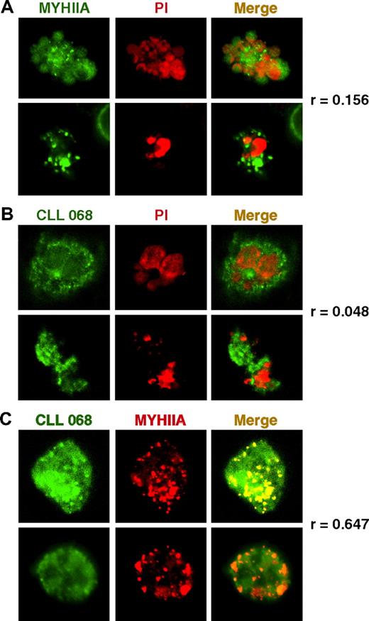 Figure 1. Apoptosis exposes MYHIIA and permits CLL subset 6 mAb reactivity. (A-B) Spontaneous apoptosis in Jurkat cells was revealed by propidium iodide (PI; red)–stained DNA in condensed nuclei. Apoptotic cells were costained under nonpermeabilizing conditions with (A) anti-MYHIIA antibody (green) or (B) CLL 068 mAb (green) and visualized by confocal microscopy (original magnification, ×600). Two representative cells from 6 independent experiments are shown with the average Pearson correlation coefficient (r) as a measure of colocalization. (C) Spontaneous apoptotic Jurkat cells were stained under nonpermeabilizing conditions with anti-MYHIIA (red) and CLL 068 mAb (green) and visualized by confocal microscopy (original magnification, ×600). Two representative cells from 3 independent experiments are shown with the average r. In all experiments (A-C), merges of red and green panels are shown (Merge; overlap in yellow-orange) and staining with secondary antibody alone was negative (not shown).