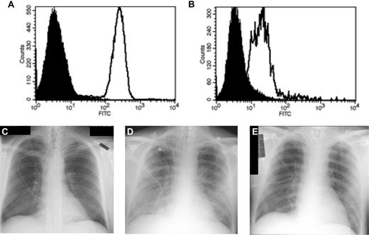 Figure 3. Acute pulmonary toxicity in patient no. 1 associated with administration of CD8+ mHAg-specific CTLs. (A-B) Flow cytometric analysis of T-cell receptor expression in CTLs before infusion (A) and after recovery from bronchoalveolar lavage fluid (B) using a human TCR Vβ13-specific monoclonal antibody. (C-E) Chest radiographs taken before (C), 4 hours after (D), and 40 hours after (E) infusion of 2.25 × 109 CTLs.