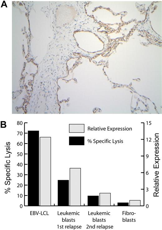 Figure 6. Expression of P2RX7 mRNA, protein, and mHAg in selected tissues. (A) Immunohistochemical analysis of P2RX7 expression in human lung. The width of the image is 936 microns. (B) Expression of P2RX7 (▩) and of the P2RX7-encoded mHAg recognized by CTL clone 11C6-109 (■) in patient no. 1–derived EBV-LCL, dermal fibroblasts, leukemic blasts obtained from patient no. 1 at the time of his first posttransplantation relapse (before T-cell therapy), and leukemic blasts obtained at the time of his second posttransplantation relapse, after the receipt of 6 CTL infusions. P2RX7 expression was assessed by real-time quantitative PCR, and mHAg expression was assessed by a 4-hour 51Cr release cytotoxicity assay at an E/T ratio of 10:1.