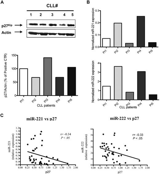 Figure 3. Expression of p27 and miR-221/222 inversely correlate in CLL cells from patients. Western blot experiment with the use of leukemic cells of 5 representative CLL cases shows variable, although readily detectable, levels of expression of p27 protein (A top). β-Actin is used as loading control. Quantification by densitometric analysis expression is reported as p27/Actin ratio between OD (A bottom). Quantitative PCR analysis for miR-221 and miR-222 (TaqMan miRNA assay) on the same patients are reported (B (top and bottom, respectively). (C) The negative correlation trendline between miR-221 (left) or miR-222 (right) and p27 in 38 patients with CLL.