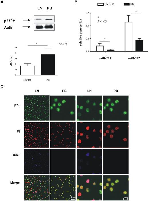 Figure 4. Differential expression of p27 and miR-221/222 in different CLL tissue compartments. Western blot analysis with the use of whole-cell lysates of purified CLL B cells from paired LN/BM and PB obtained from 7 patients. The blots were probed with anti-p27 antibodies; β-actin was used as control for equal protein loading. A representative case is shown (A top). The differences in p27 expression are quantified by densitometric analysis (A bottom). Quantitative PCR analysis (B) for miR-221 and miR-222 (TaqMan miRNA assay) quantifies the differences in expression between purified leukemic cells from paired LN/BM and PB from the same 7 patients depicted in panel A. Statistical significant differences were evaluated by the Wilcoxon test. Immunofluorescent staining with p27 (green), propidium iodide (PI; red), and Ki67 (blue) of CLL cells purified from LNs (first and third columns, 63× and 240× magnification, respectively) and PB cells (second and fourth columns, 63× and 240× magnification, respectively) of a representative patient with CLL (C; 63×/1.25 NA oil objective). LN cells exhibit lower levels of p27 in comparison to PB cells. Ki67 staining could detect positive cells only in LN cells, whereas PB cells are negative.