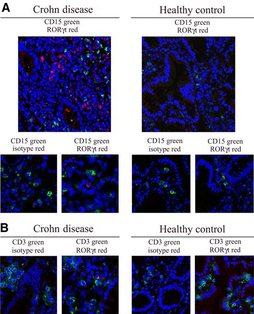 Figure 3. Neutrophils and Th17 cells colocalize in CD. (A) Confocal microscopy analysis was performed on gut tissue section of CD patients and healthy donors for CD15+ (green) and RORγt+ (red) cells. Nuclei were counterstained with TO-PRO-3 (blue). Cropped images of CD15, RORγt, and related isotype Abs (A bottom panels), as well as of CD3, RORγt, and related isotype Abs (B) are also reported (original magnification ×400, pixel 1024 × 1024). Representative images from 3 patients and 3 healthy donors. Images were acquired with a 40×/1.3 NA oil objective (corresponding to a 400× magnification). Single confocal images of cells were obtained at nuclear equatorial level by using the 1 Airy unit formula for the adjustment of the pinhole diameter, corresponding to an optical slice of 0.7 mm (for FITC emission images). Images were acquired and analyzed using the LSM 5 software (Carl Zeiss). The slides were mounted with Vectashield mounting medium (Vector Laboratories).