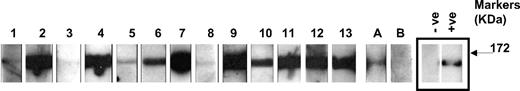 Figure 2. Analysis of antifactor H binding by Western blotting. Purified factor H was run out on 10% SDS-PAGE and transferred to nitrocellulose. Strips of nitrocellulose were then incubated with sera collected from subjects and bound antibody detected as described in “Methods.” ECL Western blotting substrate was used to visualize bound antibody. The same secondary reagent and exposure times were used throughout. Sera from known factor H autoantibody–positive and –negative subjects were used to allow standardization across multiple experiments. The positive (+ve) and negative controls (−ve) are on adjacent strips on the same autorad film and are shown as representative control signals (black box). The factor H autoantibody patients (1-13) and 2 normal subjects, A and B, are shown. These data are from a collection of sequential experiments. Molecular weight markers are shown, and the data are representative of at least 3 independent experiments.