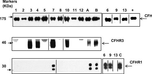 Figure 4. Analysis of factor H, factor H–related protein 3, and factor H–related protein 1 in patients with factor H autoantibodies. Sera from subjects were run out on 10% SDS-PAGE and transferred to nitrocellulose. Factor H, factor H–related protein 3, and factor H–related protein 1 were then detected by staining as described in the Methods section. ECL Western blotting substrate was used to visualize bound antibody. Sera was available from all 13 patients (samples 1-13) for analysis of factor H and factor H–related protein 1, but only from 9 patients for factor H–related protein 3. These 9 samples plus control samples were run on parallel gels. A, B, and C are normal controls known to have 2 copies of CFHR1 and CFHR3. Data from the remaining 3 samples are shown on the right. Purified factor H (equivalent to 0.5 mg/mL) was used as a positive control (+) in the smaller antifactor H blot. Black vertical lines indicate a repositioned gel lane, and black boxes illustrate the individual blots used. This figure is representative of several independent experiments.