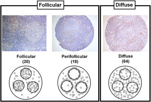 Figure 1. Representative tissue microarray cores of follicular lymphoma stained for FOXP3. The images on the left and center show the follicle-based patterns with FOXP3 cells present mostly within the follicle or around the follicle and in the mantle zone, respectively (n = 38). On the right, the image shows a diffuse case with no follicle-centered pattern defined (n = 64). Microscope: Nikon Eclipse E600; digital camera: Dxm1200.