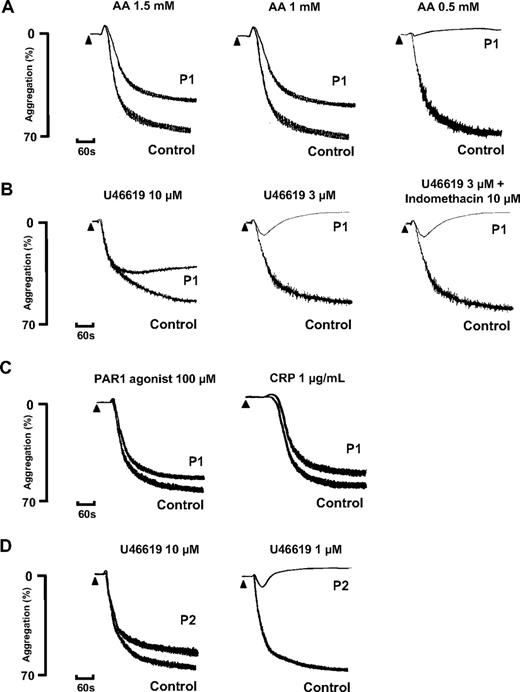 Figure 1. Agonist-induced platelet activation in subjects P1 and P2. (A-C) Platelet aggregation in response to the indicated concentrations of arachidonic acid (AA), U46619, PAR 1 agonist, and CRP in citrated PRP from subject P1 and healthy control platelets collected on the same day. Platelet aggregation to 3μM of U46619 was also tested in the presence of indomethacin (10μM). (D) Aggregation responses to U46619 are also shown in PRP from subject P2 who had the same variant D304N TxA2R as P1. The results are representative of 2 experiments.