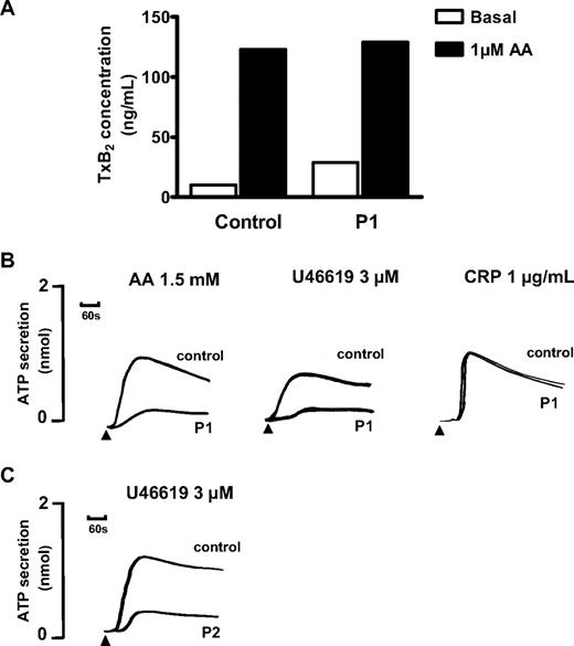 Figure 2. Agonist-induced platelet ATP secretion and thromboxane B2 synthesis. (A) TxB2 was measured by ELISA in buffer containing washed platelets from subject P1 and from a healthy experimental control at baseline and after incubation with 1μM AA. The results are from 1 experiment performed in triplicate. (B) ATP secretion in response to the indicated concentrations of AA, U46619, and CRP was determined by measuring luminescence signal from PRP in the presence of luciferase in a Chronolog lumiaggregometer. (C) ATP secretion in response to 3μM U46619 in washed platelets from subject P2, who had the same variant D304N TxA2R as P1. Data are expressed as concentration of ATP in PRP. The results are representative of 2 experiments.