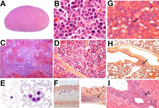 Figure 2. Histologic and cytologic analysis of TPM3-ALK–positive lymphoma and leukemic cells in blood from tTA/pBIL-TA double-transgenic mice. Hematoxylin and eosin staining on tissue sections from lymph node, spleen, kidney, lung, liver, and skin. The lymph node architecture is obliterated by abnormal lymphoid cells showing slightly irregular nuclei and scanty cytoplasms (A, original magnification ×50; B, original magnification ×1000). In the spleen, lymphoma cells are predominantly localized in the white pulp and show comparable morphologic features as seen in the lymph nodes. Note scattered megakaryocytes (arrow) (C, original magnification ×50; D, original magnification ×640). Wright-Giemsa–stained smear of peripheral blood showing presence of circulating abnormal lymphoid cells (E right, original magnification ×1000) compared with normal circulating lymphoid cells from control age-matched tTA littermate mice (E left, original magnification ×1000). All animals presented with skin nodules consisting of a hyperplasia of the epidermis, suggesting a keratoacanthoma-like lesion (F right, original magnification ×50) in comparison with normal skin from control age-matched tTA littermate mice (F left, original magnification ×50). (F right) As shown, a lymphomatous infiltration (arrow) was sometimes observed in the dermis below the keratoacanthoma-like lesion. Infiltration of various intensity was also found in kidney (G, original magnification ×400; arrow), lung (H, original magnification ×100; arrow), and liver (I, original magnification ×400; arrow).