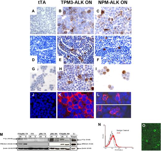 Figure 3. ALK oncogene expression in spleen, lymph node, and blood of TPM3-ALK and NPM-ALK double-transgenic mice. Immunohistochemical analysis of spleen (A-C, original magnification ×1000), lymph node (D, original magnification ×640; E-F, original magnification ×1000), blood lymphoid cells (G-I, original magnification ×1000) from control age-matched tTA (A,D,G), TPM3-ALK ON (tTA/pBIL-TA) (B,E,H), and NPM-ALK ON (tTA/pBIL-NA) (C,F,I) double-transgenic mice. Sections were stained with the rabbit anti-ALK antibody, and nuclei were counterstained with hematoxylin. NPM-ALK–positive tumor cells show a cytoplasmic and nuclear and nucleolar staining (C,F,I) in comparison with TPM3-ALK–positive tumor cells, which harbored a cytoplasmic and membrane staining (B,E,H). The staining intensity varies from cell to cell. Scattered ALK-positive lymphoma cells are observed in lymphatic sinuses (E-F). Confocal microscopy analysis shows the restricted cytoplasmic staining in TPM3-ALK (K) and the cytoplasmic and nucleolar staining in NPM-ALK (L) double-transgenic mice. Sections were stained with the mouse anti-ALK antibody, and nuclei were counterstained with TO-PRO-3 iodide. (M) Western blotting analysis of TPM3-ALK and NPM-ALK expressions. Protein lysates (100 μg) extracted from lymph nodes (LN) and spleens (S) of tTA/pBIL-TA and tTA/pBIL-NA double-transgenic mice; tTA, pBIL-TA, and pBIL-NA control transgenic mice; and positive control Karpas cell line overexpressing NPM-ALK (lane C+) were subjected to Western blotting analysis with anti-ALKc, antiphosphotyrosine, and anti–β-actin antibodies. (N) Flow cytometric analysis of ALK expression in lymph node cells from NPM-ALK double-transgenic mice. The histograms show ALK expression (red line) and isotype control (black line). Confocal microscopy (O) of lymphoma cells shows the heterogeneity of ALK expression as seen with flow cytometric analysis.