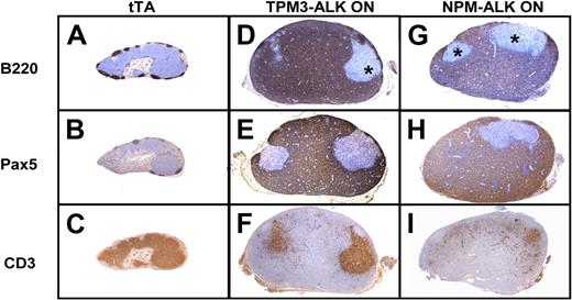 Figure 4. ALK oncogene double-transgenic mice develop B-cell lymphoma. Comparison of immunohistochemical stainings of lymph nodes from tTA control littermate (A-C), TPM3-ALK (ON; D-F), and NPM-ALK (ON; G-I) double transgenic mice. Serial sections show a massive involvement by lymphoma cells of B phenotype positive for B220 (D,G) and Pax5 (E,H). Negative areas (*) correspond to residual T cells positive for CD3 (F,I; original magnification ×40).
