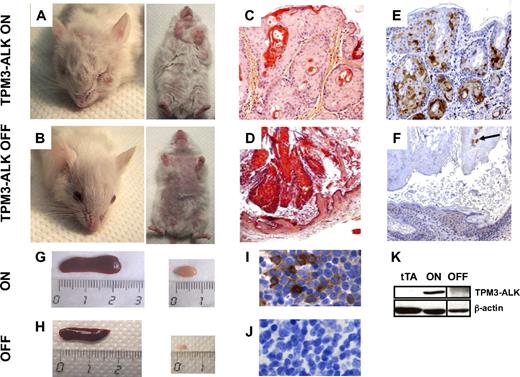 Figure 6. Lymphoma and cutaneous disease regression on ALK oncogene inactivation in TPM3-ALK mice. Clinical examination and autopsy findings show that all animals with fully developed disease (TPM3-ALK ON; n=10) presented with disseminated lymphoma with lymph node and spleen enlargement and skin nodules mostly related to keratoacanthoma-like lesions involving the skin, snout, and paws (TPM3-ALK ON: A,C,E,G,I). Ten additional moribund mice were treated with Dox in drinking water (100 μg/mL) and 1 intraperitoneal injection of 100 μL of Dox solution (100 μg/mL; TPM3-ALK OFF; B,D,F,H,J). Compared with the ON mice, the OFF mice exhibited, after 12 days of Dox treatment, a major clearing of the skin lesions (A,C vs B,D) associated with the regrowth of hair within 3 weeks, a regression of spleen and lymph node enlargement (G vs H), and an ALK oncogene expression down-regulation as assessed by anti-ALK immunostaining (E,I vs F,J) and Western blotting analysis (K lane ON vs OFF). Note, in panel K, a vertical line has been inserted to indicate a repositioned gel lane. In panel F, apoptotic ALK-positive cells admixed with exfoliated material (arrow). Original magnifications ×50 (C-F) and ×640 (I-J).