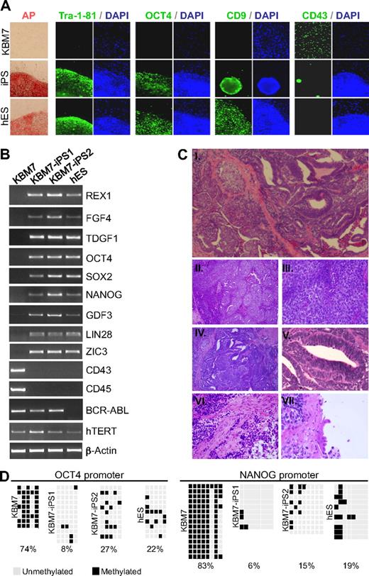 Figure 1. Generation of iPSCs derived from human KBM7 leukemic cancer cells. (A) Introduction of c-MYC, OCT4, SOX2, and KLF4 into KBM7 cells led to the formation of rare adherent colonies that displayed morphologic similarity to human embryonic stem (ES) cells as well as high alkaline phosphatase activity. Reprogrammed KBM7 cells homogeneously stained for pluripotency markers Tra-1-81 and OCT4 and CD9 but did not stain for hematopoietic CD43 (green immunofluorescence; nuclear counterstain in blue). (B) Total RNA from KBM7 cells, reprogrammed KBM7 cells, and human ES cells was isolated and analyzed by reverse-transcribed polymerase chain reaction for the expression of human ES cell characteristic transcripts REX1, FGF4, and TDGF1, endogenous OCT4 and SOX2, NANOG, GDF3, LIN28, and ZIC3, the hematopoietic specific transcripts CD43 and CD45, and the CML specific BCR-ABL fusion transcript. (C) Subcutaneous injection of cancer induced pluripotent stem cells (iPSCs; KBM7-iPS2) into non-obese diabetic severe combined immunodeficiency (NOD-SCID) mice led to formation of teratoma. Hematoxylin and eosin-stained sections of the tumor (i, original magnification ×40) revealed extensive areas of embryonal carcinoma (ii, original magnification ×100; iii, original magnification ×400) and ectoderm-derived primitive neuroectodermal tissue (iv, original magnification ×100; v, original magnification ×400). Differentiation into muscle (mesodermal; vi, original magnification ×400), and ciliated respiratory epithelium (endodermal; vii, original magnification ×600) was also present. (D) Methylation analysis of the OCT4 and NANOG promoter region in KBM7 cells, the generated iPSCs, and hES cells. Light gray squares represent unmethylated; black squares, methylated cytosine-phosphate-guanosine. Numbers indicate the percentage methylated cytosine-phosphate-guanosine.