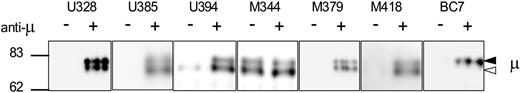 Figure 3. Analysis of μ chain–associated phosphoprotein after treatment with anti-μ. Normal B cells (BC7) and CLL cells were treated with anti-μ (+) or isotype control (−) for 2 minutes. Immunoprecipitations were performed with antiphosphotyrosine antibody 4G10, and μ chain was analyzed by immunoblotting. Immunoblots show results from 1 healthy donor and 6 CLL samples. The immature form (◁) and the mature form (◀) of μ chain are indicated.