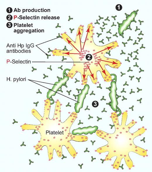 (1) IgG antibodies to Heliobacter pylori are generated. (2) H pylori with the IgG antibodies induce platelet activation and movement of P-selectin to the platelet surface. (3) Interaction of H pylori, Hp IGs, and P-selectin leads to platelet aggregation and apoptosis, reducing the number of ciculating platelets. Professional illustration by Paulette Dennis.