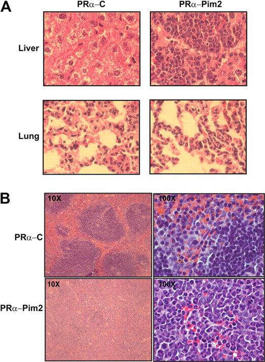 Figure 4. Histopathology of mice receiving transplants of Pim2–PML-RARα or empty vector–PML-RARα HPCs. Histologic sections from liver, lung (A), and spleen (B) were stained with hematoxylin and eosin (×40 magnification for A and B; ×10 and ×100 magnification for B). Note the myeloid infiltrate in the organs of Pim2-PRα mice.