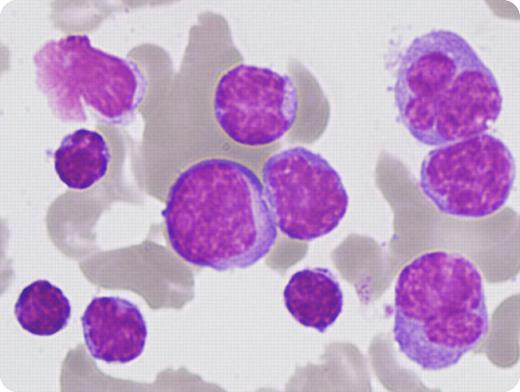 A 75-year-old woman with a 7-year history of chronic lymphocytic leukemia (CLL), previously treated with fludarabine and cyclophosphamide, was admitted with weight loss, night sweats, and fevers. She had widespread low-volume lymphadenopathy and a palpable spleen but no new large nodal mass. The complete blood count showed hemoglobin 112 g/L, white blood cell count 11.92 × 109/L, lymphocytes 10.73 × 109/L, and platelets 67 × 109/L. Two weeks later, her white cell count had risen to 92 × 109/L, and platelet count had fallen to 22 × 109/L. Her LDH was 3859 U/L. She died shortly thereafter. / Her blood film showed 2 separate populations of lymphocytes. The first were small with clumped chromatin and scanty cytoplasm, typical of CLL cells. The second were larger pleomorphic cells with abundant, vacuolated cytoplasm and distinct nucleoli (see image). Flow cytometry affirmed the small lymphocyte population, consistent with her known CLL: coexpression of CD19, CD20, CD5, CD23, dim κ chain restriction, and negative for FMC7, CD79b, and CD22. However, the larger cell population was positive for FMC7, CD79b, and CD22 with strong expression of kappa and CD20. These findings confirmed a leukemic Richter transformation. / Richter transformation can occur in up to 10% of patients with CLL. It is heralded by a sudden clinical deterioration characterized by a rapid increase in lymphadenopathy, extranodal involvement, splenomegaly, worsening “B” symptoms, and rapid rise in LDH. The prognosis is very poor and therapeutic options are limited.