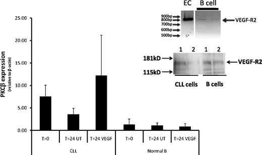 Figure 4. VEGF does not stimulate PKCβ gene expression in normal B cells. Quantitative RT-PCR analysis of PKCβ mRNA levels in CLL (n = 6) and normal peripheral B cells (n = 3) incubated in the presence and absence of 100 ng/mL VEGF for 24 hours and compared with control uncultured cells. The PKCβ mRNA levels are reported relative to β-actin mRNA levels in the same cell in arbitrary units. (Inset) RT-PCR analysis of VEGF-R2 expression in normal B cells and in an endothelial cell line (EAhy926; top panel) and Western blot analysis of VEGF-R2 protein expression in CLL- and normal B-cell lysates (equal amounts of protein were loaded onto the gel).