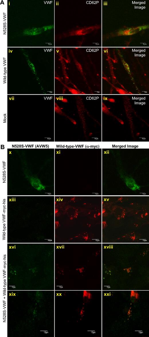 Figure 6. VWF granule biogenesis in HEK293 cells transfected with mutant and wild-type VWF. (A) K9-VWD-AECs were transiently transfected with N528S-VWF, wild-type VWF, or pCIneo (Mock). Cells were immunostained for VWF (green; i, iv, vii) and P-selectin/CD62P (red; ii, v, viii) and intracellular localization examined by confocal microscopy. The merged image is shown in the last column with colocalization shown in yellow (iii, vi, ix). Wild-type VWF formed granules and recruited CD62P, whereas N528S-VWF failed to form granules. (B) HEK293 cells were transiently transfected with N528S-VWF, wild-type VWF-myc-his, or heterozygous N528S-VWF/wild-type VWF-myc-his. Cells were immunostained using monoclonal AVW-5 that does not recognize wild-type VWF-myc-his (green; x, xiii, xvi, xix) and rabbit antimyc that does not recognize the N528S-VWF lacking a myc-his tag (red; xi, xiv, xvii, xx). Intracellular localization was determined by confocal microscopy and the merged image shown in panels xii, xv, xviii, and xxi. When expressed alone, wild-type VWF formed granules, whereas N528S-VWF did not. When coexpressed, both N528S-VWF and wild-type VWF are localized in granules.