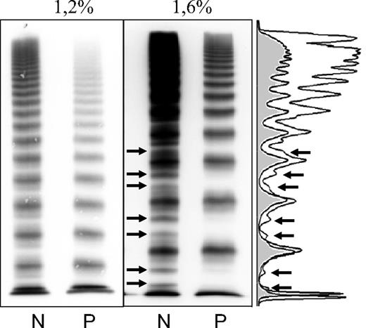 Figure 1. VWF multimers of a patient with VWD subtype 2A/IIE (mutation p.C1173R). Low (1.2%) and medium (1.6%) resolution gel. Densitometric evaluation of the 1.6% gel. Arrows point to the outer proteolytic bands only visible in the normal multimers (N). The patient's multimers (P) lack the outer proteolytic bands, a characteristic feature of this subtype.