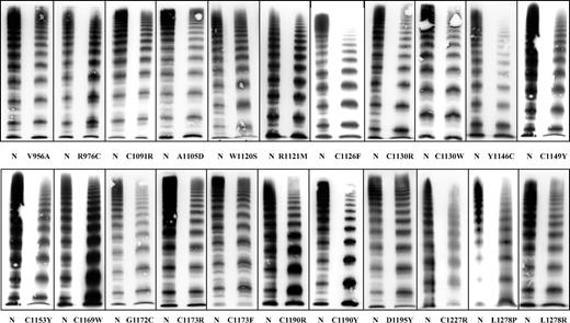 Figure 2. VWF multimers of 22 index patients with VWD subtype 2A/IIE corresponding to 22 different mutations. Although there is some phenotypic heterogeneity, the common feature of a relative loss of large multimers and/or decreased proteolysis is seen in all of them.