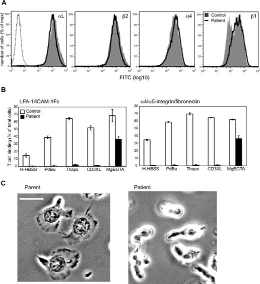 Figure 1. Characterization of a new LAD-III patient. (A) Expression levels of β2 integrin αLβ2 (LFA-1) and β1 integrin α4β1 are equivalent between LAD-III patient and control T lymphoblasts (control cells: gray fill; patient cells: dark line; representative mAb control: dashed line; n = 2). (B) Adhesion to LFA-1 ligand ICAM-1 and α4β1/α5β1 ligand fibronectin after inside-out signaling mediated by phorbol ester (PdBu), Ca2+ mobilizer thapsigargin (Thaps), or CD3 mAb cross-linking of the T-cell receptor/CD3 complex (CD3XL) and “outside-in” signaling via Mg2+/EGTA treatment (samples in triplicate; n = 2). (C) Attachment of T lymphoblasts to ICAM-1. The parent T cells spread as expected, whereas the patient T cells were lightly attached and failed to spread. Images are representative of 25 cells/experiment; n = 3. Scale bar represents 10 μm.