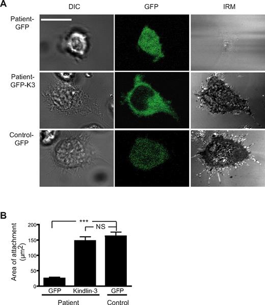 Figure 3. Adhesion characteristics of LAD-III T lymphocytes expressing WT kindlin-3. (A) Differential interference contrast (DIC), GFP, and IRM images of the patient T lymphoblasts transfected with GFP (top panel) and mouse GFP-kindlin3 cDNAs (middle panel) compared with the GFP-transfected control T lymphoblasts (bottom panel). Images are representative of 11-15 cells; n = 3. (B) Quantification of the area of close contact of the same cells; n = 11 cells per group.