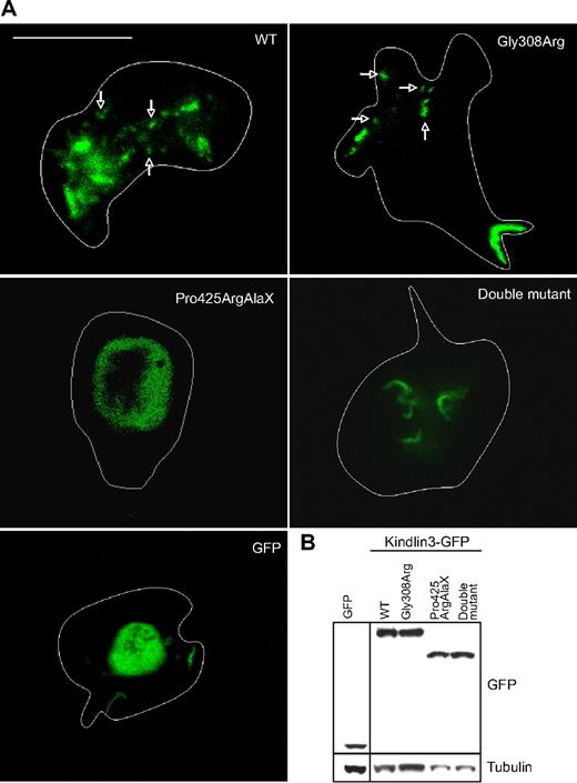 Figure 5. Confocal microscopy of LAD-III B cells transfected with human KINDLIN3-GFP cDNA constructs. (A) FACS-sorted LAD-III B cells transfected with GFP cDNA were compared with cells transfected with WT KINDLIN3, Gly308Arg, Pro425ArgAlaX, and double mutant KINDLIN3-GFP cDNAs. Fluorescent images of live B cells taken at the interface with ICAM-1 show punctate membrane localization (arrows) of WT and Gly308Arg Kindlin-3-GFP protein compared with other transfectants showing a diffuse distribution of fluorescence in the cell body and extensions. The boundaries of the cells are highlighted with a white line. Only the WT and Gly308Arg KINDLIN3-GFP cDNA–transfected cells adhered well. The cells are typical examples from 1 experiment of n = 4. Scale bar represents 10 μm. (B) Western blot of GFP, WT kindlin-3-GFP, full-length Gly308Arg, and truncated Pro425ArgAlaX and double mutant kindlin-3-GFP proteins expressed in EBV-transformed B cells and showing the expected molecular size. Loading control is α-tubulin.