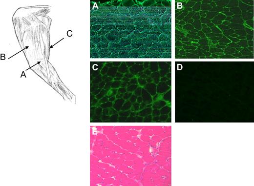 Figure 2. Canine FIX staining and histology of muscle biopsies from dog H48 (3 × 1012 vg/kg) 2 years after ATVRX delivery of an AAV2-cFIX vector. Left panel, sites of muscle biopsy sampling, AAV-injected target limb: (A) semimembranosus; (B) vastus lateralis; (C) semitendinosus. (A-C) cFIX immunostaining of muscle biopsies collected at the sites indicated. (D) cFIX immunostaining of muscle biopsies from the contralateral, noninjected limb. (E) Hematotoxylin and eosin staining of the muscle biopsy collected from the target leg. Images are taken at 100× magnification.