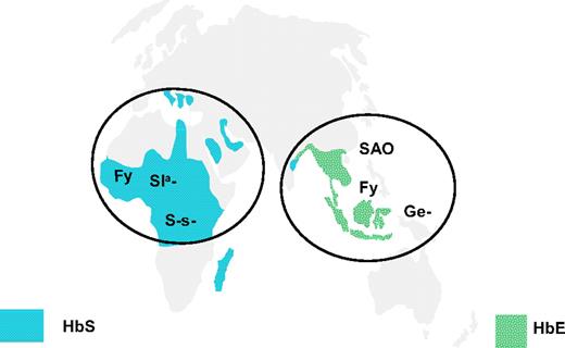Figure 4. Distribution of rare blood group phenotypes selected by malaria in Africa and South East Asia. The location of rare blood group phenotypes lacking glycophorin B (S-s−), having altered glycophorin C (Ge−; Gerbich-negative), Fy (Duffy) blood group–null allele (Fy), Sl(a−) allele of complement receptor 1 (CR1), and the Band 3 mutation causing South East Asian ovalocytosis (SAO) in comparison with the distribution of HbS and HbE alleles.72