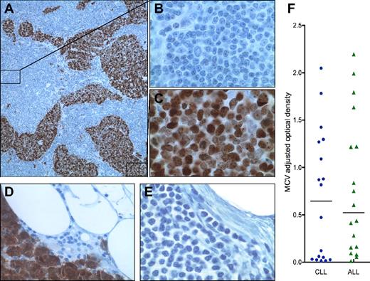 Figure 1. (A) Case 1: lymph node with both CLL (10×/0.30 NA; B) and metastatic MCC (100×/1.40 NA oil objective; C) immunohistochemically stained (Dako EnVision+ Kit) with CM2B4,8 a mouse monoclonal antibody specific to MCV T antigen; and counterstained with hematoxylin. Case 2: MCC metastatic to lymph node showing strong nuclear expression of MCV T antigen expression (40×/0.75 NA; D) and CLL (40×/0.75 NA; E) demonstrating effacement of normal nodal architecture with a population of cells comprised predominantly of small lymphocytes with scant cytoplasm, round nuclei, and clumped chromatin. Images were acquired on an Olympus Provis AX70 using Spot 3.5.9 software for Mac OS (Diagnostic Instruments). All images were processed using Adobe Photoshop CS3. (F) Anti-MCV antibody levels (colored dots and triangles), as measured with MCV virus-like particle enzyme immunoassay (VLP EIA), are not significantly different in sera from CLL and ALL patients. Median MCV optical density values are indicated by horizontal lines, with bars representing interquartile values.