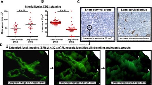 Figure 1. Increase in the presence of small vessels in poor prognosis FL identified as angiogenic sprouts using extended focal imaging. (A) CD31 was examined using TMA cores from extremes of survival diagnostic FL biopsies (< 5-year short-survival group and > 15-year long-survival group). Dot-plot chart shows significantly decreased interfollicular CD31+ mean vessel area (μm2) in the short-survival group. Each dot represents an FL patient (mean of triplicate cores) using the TMA. (B) Dot-plot chart shows significantly increased interfollicular CD31+ vascular structures measuring less than 30 μm2 in the short-survival group. Each dot represents a single core (triplicate cores per patient) using the FL extremes of survival TMA. Statistical analysis was performed using a mixed-effects linear model (P values). The black bar represents the mean value for each experimental group. (C) Representative low power (original magnification ×20) images of CD31 interfollicular staining on TMA cores from the short-survival group (left-hand image) and the long-survival group (right-hand image). Note the increase in small, vascular structures measuring less than 30 μm2 in the poor prognosis FL biopsy. The long-survival group exhibited larger mean vessel areas. Image acquisition: Olympus BX61 camera (Applied Imaging), 20×/0.5 numeric aperature (NA); images imported to Ariol Genetix Version 3.2.125 (Applied Imaging). (D) CD31 vascular structures present in the extremes of survival FL TMAs were examined using extended focal imaging (EFI). This technique builds a composite image of a focal series from 50-μm-thick whole sections that can be reconstructed with height lines in 3 dimensions (3-D) using image analysis software (process denoted by black arrows). This EFI analysis identified that the CD31+ vessels measuring less than 30 μm2 in the short-survival FL group (C ●) were blind-ending sprouting processes. The white arrows indicate blind-ending vessels in the poor prognosis FL biopsies identified using EFI. Image acquisition: Olympus BX61 camera (Applied Imaging), 40×/0.75 NA; images constructed by CellF Version 24 (Olympus).