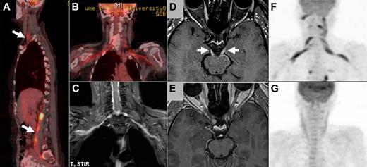 Figure 1. Imaging studies in NL. (A-B) FDG-PET imaging of a patient with neurolymphomatosis (NL). (A) Multiple sites of involvement, including the brachial and lumbosacral plexi (arrows). (B-C) Bilateral involvement of the brachial plexus in the same patient clearly detected by both FDG-PET (B) and by MRI (C) T2 short T1 inversion recovery imaging. (D-E) Enhanced MRI imaging (T1-weighted with gadolinium) of a patient with NL that affected multiple cranial nerves. (D) Bilateral abnormal enhancement of the oculomotor nerves that corresponded to the clinical presentation of bilateral ophthalmoplegia. (E) Complete resolution of abnormal enhancement after 2 cycles of treatment with intravenous high-dose methotrexate and intra-CSF treatment with cytarabine. These imaging findings matched the marked neurologic improvement observed under treatment. (F-G) FDG-PET imaging of a patient with NL who presented with severe painful sensorimotor neuropathy and bilateral brachial plexus involvement. (F) FDG-PET findings at diagnosis of NL compatible with bilateral brachial plexus involvement by lymphoma. (G) Complete resolution of abnormal tracer uptake after 2 courses of treatment with systemic high doses of methotrexate and cytarabine. The treatments lead to clear neurologic improvement and good control of the painful neuropathy.