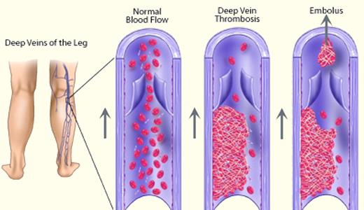 Deep venous thrombosis.