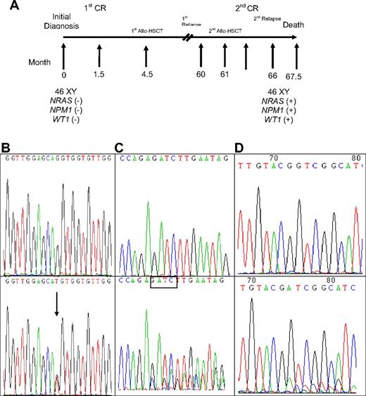 Figure 1. Sequential analyses of NRAS, NPM1, and WT1 mutations in patient 33 showing acquisition of novel mutations in these 3 genes at relapse. (A) Sequential follow-up of mutation pattern at Patient 33. (B) Wild-type NRAS at diagnosis (top) and GGT>TGT at NRAS codon 12 at relapse (bottom). Arrows indicate the location of the mutation. (C) Wild-type NPM1 at diagnosis (top); NPM1 mutation with a TCTG insertion at relapse (bottom). The boxed tetranucleotides indicate the location of the mutation. (D) Wild-type WT1 at diagnosis (top) and nt1335/1336 (+11 bp) on exon 7 at relapse (bottom).