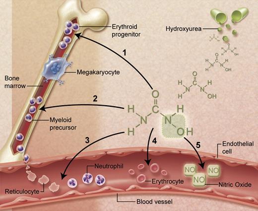 Figure 2. Multiple beneficial effects of hydroxyurea for SCA. (1) Fetal hemoglobin induction through soluble guanylyl cyclase activation and altered erythroid kinetics; (2) lower neutrophil and reticulocyte counts from ribonucleotide reductase inhibition and marrow cytotoxicity; (3) decreased adhesiveness and improved rheology of circulating neutrophils and reticulocytes; (4) reduced hemolysis through improved erythrocyte hydration, macrocytosis, and reduced intracellular sickling; and (5) Nitric oxide (NO) release with potential local vasodilatation and improved vascular response. Illustration courtesy of Alice Y. Chen.