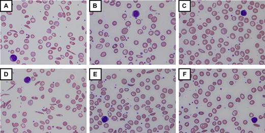 Figure 3. Laboratory and morphologic changes during hydroxyurea dose escalation to MTD. Increases in hemoglobin (Hb), mean corpuscular volume (MCV), and percentage fetal hemoglobin (HbF) occur simultaneously with decreases in white blood cell count (WBC), absolute neutrophil count (ANC), ARC, and lactate dehydrogenase (LDH). Morphologic changes to the erythrocytes include nonreticulocyte macrocytosis, increased numbers of target cells, fewer sickled forms, and relative “blunting” of the sickled cells that remain in circulation. (A-C) Changes from baseline through dose escalation to maximum tolerated dose (MTD) for a child with high HbF response (∼ 30% HbF at 30 mg/kg/d). (D-F) Changes for a child with low HbF response (∼ 15% HbF at 25 mg/kg/d). Despite the differences in HbF response, both patients have marked improvements in the peripheral blood smear morphology. For all panels, images were visualized using an Olympus BX40 microscope (Olympus America) with a 100×/1.25 numeric aperture oil-immersion objective (Resolve Microscope immersion oil, Thermo Scientific); photographs were taken with an Olympus DP20-SE digital camera, processed using Olympus DP2-BSW application software, and displayed using Microsoft Office PowerPoint 2003. Photographs courtesy of Nicole A. Mortier.