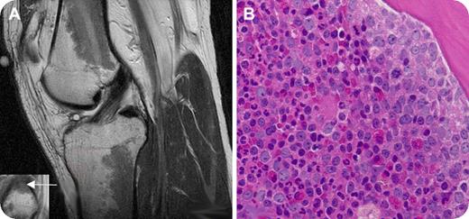 A 27-year-old man presented with a complaint of several months of progressive left knee pain with ambulation. An MRI scan of the left knee revealed extensive intermediate-low-signal intensity within the bone marrow in the diametaphyseal regions of the distal femur and proximal tibia (panel A, sagittal T2-weighted image of knee joint) and the epiphysis of the proximal fibula (panel A inset, coronal T1-weighted detail of fibular epiphysis; the arrow shows the bone marrow abnormality). The patient denied a history of knee trauma and was otherwise healthy. He had no knee abnormality on examination. There was no enlargement of lymph nodes, liver, or spleen. / Laboratory tests showed a white blood cell count of 25.3 × 109/L with 55% neutrophils, 8% bands, 5% myelocytes, 6% metamyelocytes, 21% lymphocytes, 4% monocytes, and 1% basophils; hematocrit of 43.7%; and platelet count of 203 × 109/L. A bone marrow aspirate and biopsy from the left posterior-superior iliac crest revealed hypercellularity with granulocytic predominance (panel B). Karyotypic analysis revealed a Philadelphia chromosome (t (9;22)). The patient was diagnosed with chronic myelogenous leukemia (CML) and therapy with imatinib mesylate was initiated. / The abnormalities on the MRI scan, when viewed in the absence of known hematologic abnormalities, were initially attributed to red marrow reconversion, which may be secondary to athletic activity. However, similar findings can indeed be seen in myeloproliferative disorders and marrow replacement disorders. Clinicians should be aware of unusual presentations of hematologic disorders in seemingly healthy patients with abnormal bone marrow signal on MRI scans.