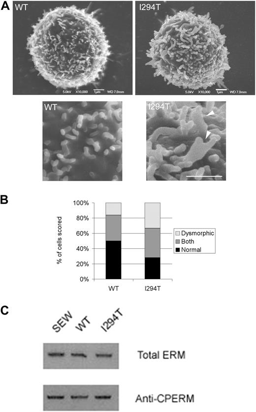 Figure 4. WASpI294T 300.19 cells form dysmorphic microvilli. (A) SEM micrographs of WASpWT and WASpI294T 300.19 cells. Enlarged sections of the same cells are shown in the bottom panels, with dysmorphic microvilli visible in WASpI294T cells (arrowheads). Scale bars represent 1 μm. Images were acquired viewing in a JEOL 6700F FESEM, captured using JEOL software and analyzed with Adobe Photoshop (crop, image size, and brightness/contrast functions only). (B) Cells were blindly scored by 2 independent reseachers for presence of normal fingerlike or dysmorphic broad microvilli. The quantification for at least 50 cells from each condition is shown. WASpI294T cells showed a significantly increased percentage of cells predominantly forming dysmorphic structures and a significantly reduced percentage of cells with a predominance of fingerlike microvilli (P < .05 for both; Fisher exact 1-tailed test). (C) Anti–p-ERM Western blotting of extracts derived from 300.19 cells expressing EGFP (SEW), WASpWT, or WASp reveals that overall ERM activity remains unaltered between the cell types. Top panel represents Western blot of p-ERM; bottom panel, total ERM staining to monitor equal loading between samples. Immunoblots are representative of 3 independent experiments.