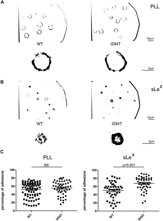 Figure 7. WASpI294T 300.19 cells display altered contact dynamics to L-selectin ligand. (A) WASpWT and WASpI294T 300.19 cells were plated on either PLL or sLex (B) and were imaged by rapid time-lapse IRM. sLex was immobilized as described in supplemental Methods using glass coverslips. Images were acquired in normal growth medium at 37°C using a Zeiss Standard18 microscope with IV-FL incident light fluorescence attachment, appropriate filters for IRM acquisition, and a Zeiss 63×/1.25 NA Neofluar Antiflex oil-immersion objective and a Pulnix CCD camera (Jai Ltd) using in-house acquisition software (Matrox Video and Imaging Technology Europe Ltd). Composite images of 4 consecutive frames analyzed for adhesion contacts (using Adobe Photoshop as described in supplemental Methods) are shown with a full-field view above an enlarged individual cell. Separate scale bars are shown for original magnification and enlarged images. Stable adhesions appear as black/dark gray pixels, whereas dynamic adhesions appear light gray. WASpI294T cells show an increase in stable adhesions compared with WASpWT cells when adherent to L-selectin ligand (sLex) but not to PLL. (C) Stable adhesions were calculated for individual cells and displayed as a percentage of total adhesion pixels. Quantifications of stable adhesions are shown for PLL and sLex in left and right panels, respectively. WASpI294T cells demonstrate a significant increase in stable adhesions when adherent to sLex but not PLL (P < .001; 2-tailed t test).