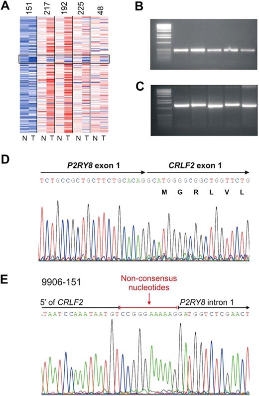 Figure 3. Characterization of PAR1 deletion centromeric to CRLF2 and PCR detection of the P2RY8-CRLF2 fusion. (A) Representative log2 ratio SNP 6.0 microarray DNA copy number data for 5 samples with PAR1 deletions. SNP array data derived from matched normal DNA is indicated by “N” and the leukemic sample with “T.” The black box highlights the region of PAR1 deletions. (B) RT-PCR demonstrating the fusion transcript of P2RY8 and CRLF2. Full-length cDNA transcripts were subjected to PCR with primers from P2RY8 and CRLF2 to generate the fusion products. (C) Genomic PCR of the chromosomal breakpoints joining CRLF2 and P2RY8. (D) Sequence of the RT-PCR product showing the junction of exon1 of P2RY8 with exon 1 of CRLF2. P2RY8 exon 1 is noncoding. (E) Germline sequence of the breakpoint. The exact junction of 5′ flanking sequence of CRLF2 to intron 1 of P2RY8 is shown. Several nonconsensus nucleotides are present at the junction.
