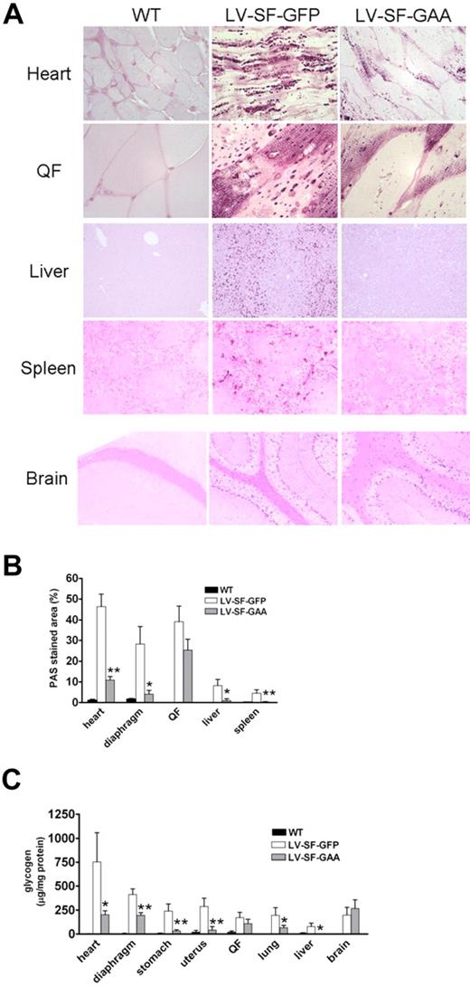 Figure 2. Glycogen deposition in WT and Gaa−/− mice that received a transplant of LV-SF-GFP and LV-SF-GAA. (A) PAS staining (dark purple stain) shows glycogen deposition in heart, QF, spleen, liver, and brain (cortex) of 8-month-old mice that received a transplant of LV-SF-GFP. Clearance of glycogen is observed in liver and spleen of mice that received a transplant of LV-SF-GAA. Reduction of glycogen storage is observed in heart and skeletal muscle. Brain does not respond. Heart and QF, original magnification ×1000; liver, spleen, and brain original magnification ×125. (B) Quantification of the PAS staining by ImageJ shows a reduction of glycogen storage in heart, diaphragm, liver, and spleen but only marginal reduction in QF at 8 months after transplantation. PAS stained area as the percentage of total area is presented for LV-SF-GFP and LV-SF-GAA groups (n = 4-6); *P < .05 and **P < .01 indicate a significant difference between mice that received a transplant of LV-SF-GAA and LV-SF-GFP. (C) Enzymatic quantification of the glycogen deposition in tissues at 8 months after transplantation. The figure shows a reduction of glycogen in all tissues tested except brain (n = 4-11); *P < .05 and **P < .01 indicate a significant difference between mice that received a transplant of LV-SF-GAA and LV-SF-GFP.
