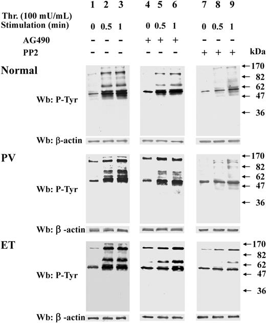 Figure 1. Analysis of protein Tyr phosphorylation in resting and thrombin-challenged platelets isolated from blood of healthy donors or Ph-MPD patients. Platelets were obtained from healthy donors, and PV or ET patients as detailed in “Platelet isolation and treatment.” Cells were stimulated with 100 mU/mL thrombin (Thr) for the indicated times in the presence of vehicle (lanes 1-3), or 10μM AG490 (lanes 4-6), or 10μM PP2 (lanes 7-9). Platelets were then lysed and analyzed by Western blot with anti–P-Tyr and β-actin (loading control) antibodies as described in “Western blot analysis of cellular lysates.” The figure is representative of experiments performed with 20 normal, 11 PV, and 30 ET samples.