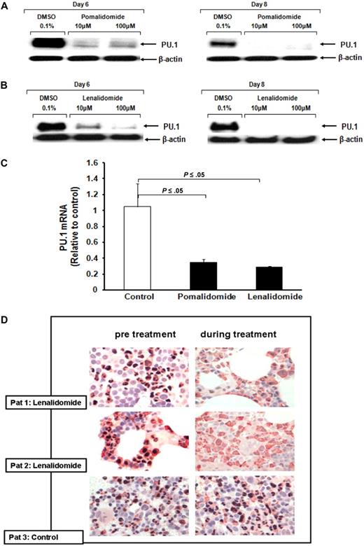 Figure 3. IMiDs down-regulate PU.1 in myeloid progenitors in vitro and in patients. Purified CD34+ cells were cultured in the presence of DMSO (control), (A) pomalidomide, or (B) lenalidomide for 6 and 8 days, and PU.1 protein expression was determined. β-Actin served as loading control. (C) CD34+ cells were cultured in the presence of DMSO (control), pomalidomide, or lenalidomide for 3 days. Total RNA was extracted and then subjected to quantitative RT-PCR. Data were analyzed according to the ΔCT method. Results are shown as mean CG mRNA fold increase by pomalidomide or lenalidomide compared with baseline (control). The level of mRNA was normalized to GAPDH expression. (D) Double labeling immunohistochemistry on paraffin-embedded bone marrow biopsy sections for PU.1 expression (black nuclear staining) and myeloperoxidase (red cytoplasmic staining) before and during treatment with either lenalidomide or dexamethasone (control). Slides were evaluated using an Olympus BX45 microscope equipped with a 100×/1.35 numeric aperture (Olympus; original magnification ×1000).