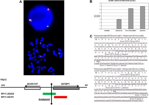 Figure 1. Genetic characterization of a patient with AML-M5 and a t(12;18)(p13;q12) involving ETV6. (A) FISH analysis indicating the breakpoint on 18q12: probe RP11-252G8 (green) splits and hybridizes in both der(18) and der(12). (B) Analysis by quantitative RT-PCR of the SETBP1 expression in samples of the patient at diagnosis, posttreatment control, and relapse. (C) RACE results showing the 2 different fusion transcripts detected. Sequences from ETV6 are in italics; the putative exons from chromosome 18 are underlined.