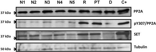Figure 3. Comparison of the PP2A and SET protein levels by Western blot between patient samples and normal donors. Phosphorylation on tyrosine-307 of PP2A is also assessed. The K562 cell line was used as a positive control for SET overexpression and hyperphosphorylation of Y-307 of PP2A. N1-N5 indicates normal controls; R, patient sample at relapse; PT, patient sample after treatment; D, patient sample at diagnosis; and C+, K562 cells as positive control.