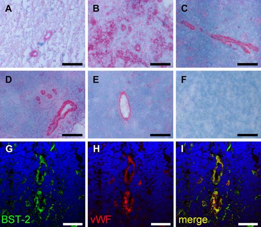 Figure 6. Expression of BST-2 in human non-Hodgkin lymphoma. BST-2 was detected in vascular structures of aggressive (A-C) and indolent (D-E) human non-Hodgkin lymphoma specimens using alkaline phosphatase–antialkaline phosphatase immunohistochemistry. Representative images of diffuse large B-cell lymphoma (A), Burkitt lymphoma (B), mantle cell lymphoma (C), follicular lymphoma (D), and chronic lymphocytic leukemia (E) are presented. Negative controls omitting the primary antibody were consistently negative (F). Although in most cases a predominant vascular staining was observed, also tumor cells were strongly immunostained in a case of Burkitt lymphoma (B). Slides were viewed with an Axiovert S100TV microscope (Carl Zeiss) using a 20×/0.40 Korr Ph2 objective and Glycergel Mounting Medium (Dako). Images were acquired using an AxioCam color camera and AxioVision software Version 4.7.1.0 (Carl Zeiss). Images were manipulated using ImageJ, Version 1.42q (available at http://rsb.info.nih.gov/ij/; A-F). Confocal images illustrate the colocalization of BST-2 and von Willebrand factor (vWF), exemplified on a section of chronic lymphocytic leukemia (G-I). Scale bars represent 100 μm (A-F) and 50 μm (G-I). Slides were viewed with an LSM510 Meta confocal microscope (Carl Zeiss) using 10×/0.45 W and 40×/1.2 W water objectives and Fluorescent Mounting Medium (Dako). Images were acquired with the LSM510 Meta confocal laser scanning microscope and software provided by the manufacturer (Carl Zeiss). Images were manipulated using ImageJ software, Version 1.42q (available at http://rsb.info.nih.gov/ij/; G-I).