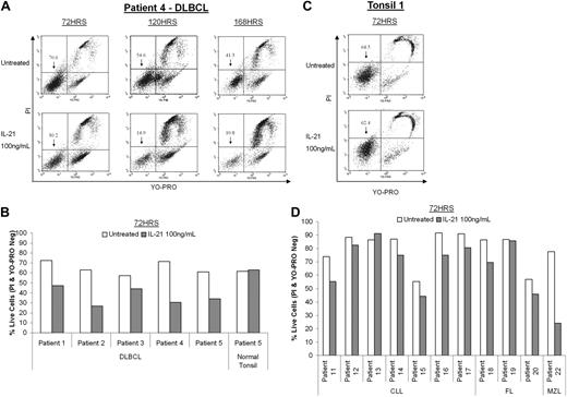 Figure 3. IL-21 induces apoptosis in DLBCL primary tumors. Neoplastic or healthy B cells isolated from primary de novo tumors or normal tonsils were treated with IL-21 (100 ng/mL) for the specified time period and viability was assayed using YO-PRO/PI staining. (A) Flow cytometric profiles of B cells isolated from one representative DLBCL primary tumor originating from patient 4 and stained with YO-PRO/PI. (B) Compilation of viability data for B cells isolated from 5 DLBCL primary tumors and 1 healthy tonsil tested by flow cytometry after 72 hours of IL-21 treatment. (C) Flow cytometric profiles of healthy B cells isolated from a representative normal tonsil (tonsil 1) and stained with YO-PRO/PI. (D) Compilation of viability data for B cells isolated from 7 chronic lymphocytic leukemia (CLL), 3 follicular lymphoma (FL), and 1 marginal zone lymphoma (MZL) patient samples tested by flow cytometry after 72 hours of IL-21 treatment.