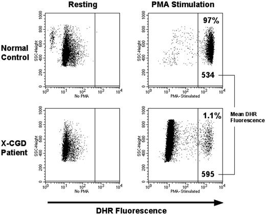 Figure 5. Flow cytometry panel showing DHR analysis for patient 1 at 2 years after gene therapy. Patient 1 who had the best results continues to have approximately 1% DHR-positive cells in the peripheral blood. The MFI for this patient's cells is consistently in the same range as the normal control run concurrently, indicating a close to normal level of oxidase production on a per cell basis.