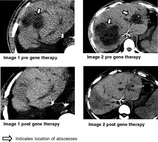 Figure 7. Clinical results for patient 1. Shown here are the CT scans obtained before gene therapy and 6 months after gene therapy for patient 1 who had biopsy-proven Staphylococcal aureus liver abscesses as indicated by the arrow. These disappeared, leaving only some scarring and regenerating liver as shown in the corresponding post films.